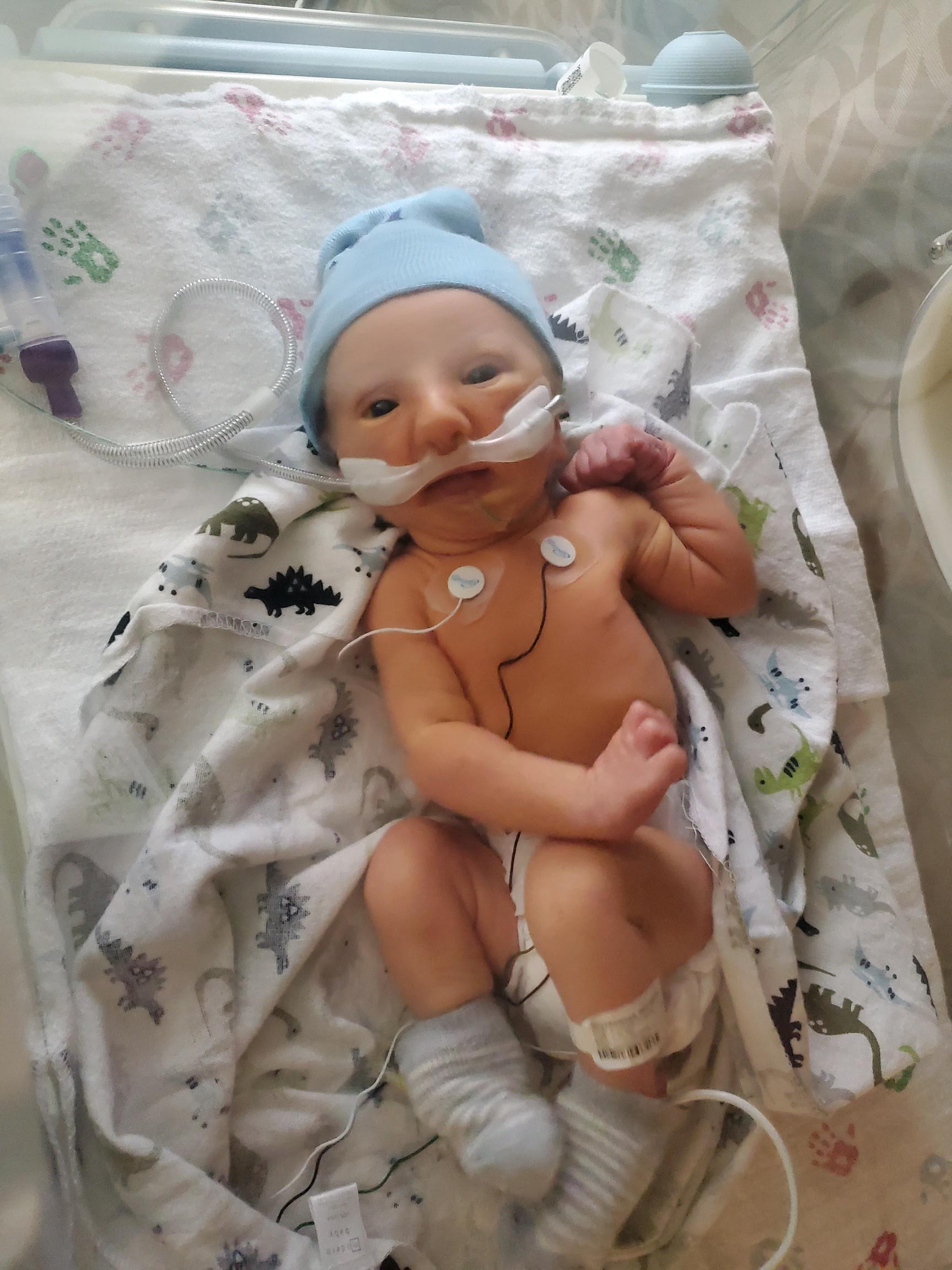 Patrick as a newborn baby with Trisomy 9