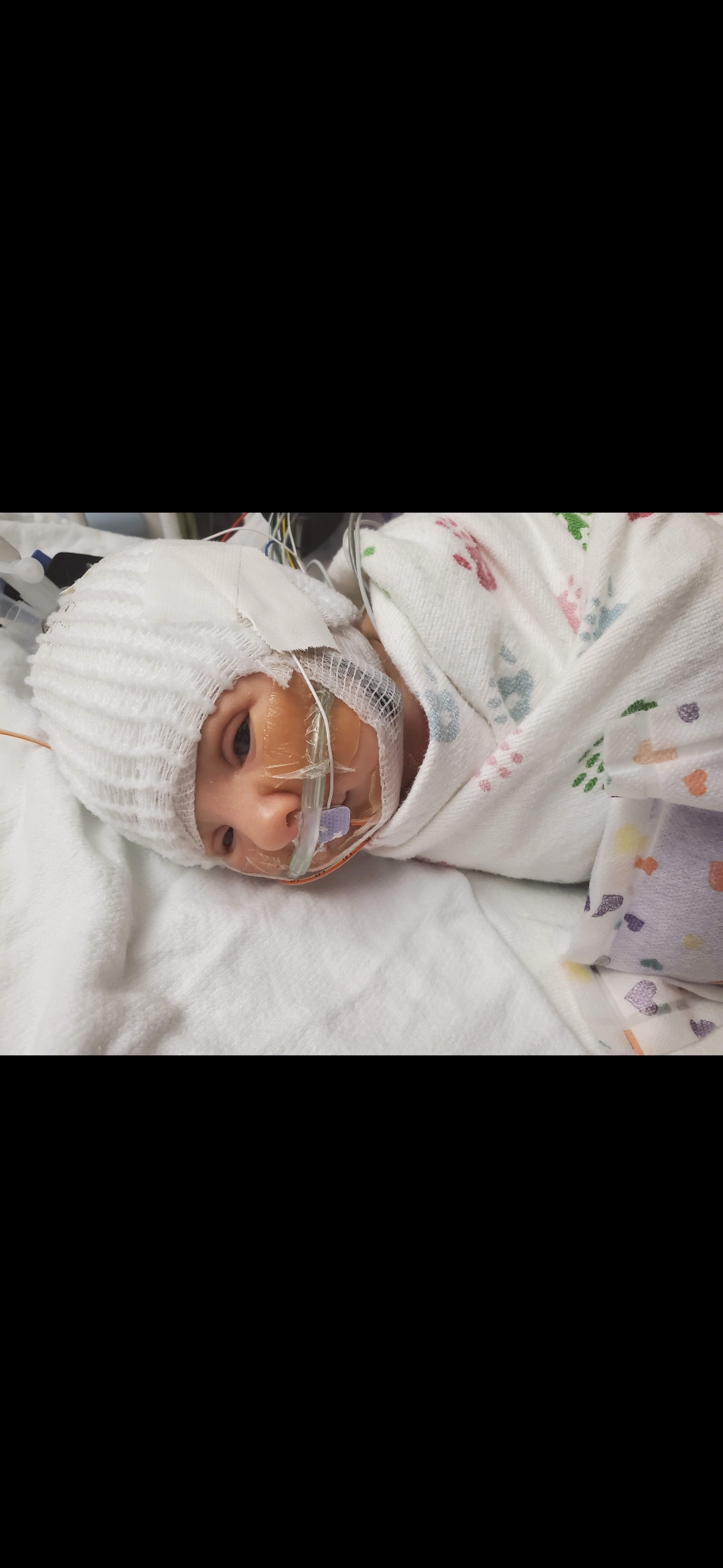 Baby Patrick at Lurie Children's Hospital — Trisomy 9