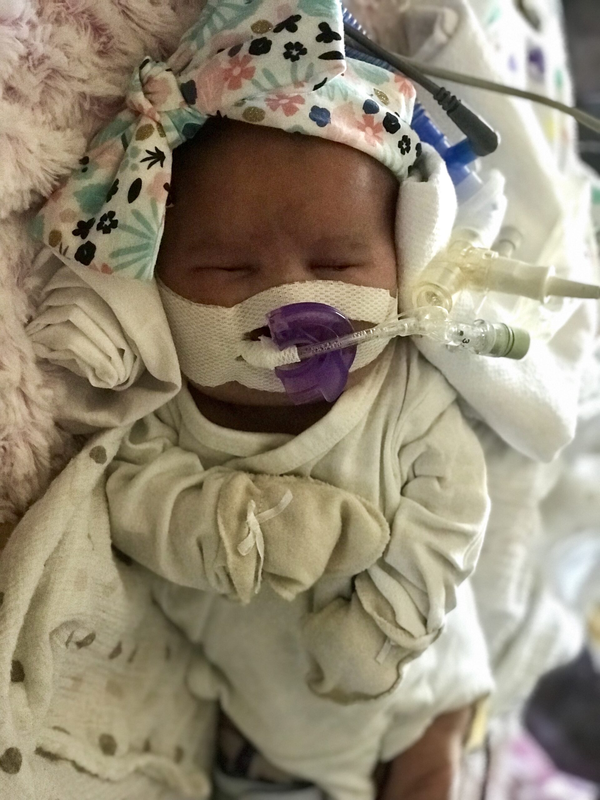 Newborn Izzy Farmer with breathing tubes in the NICU
