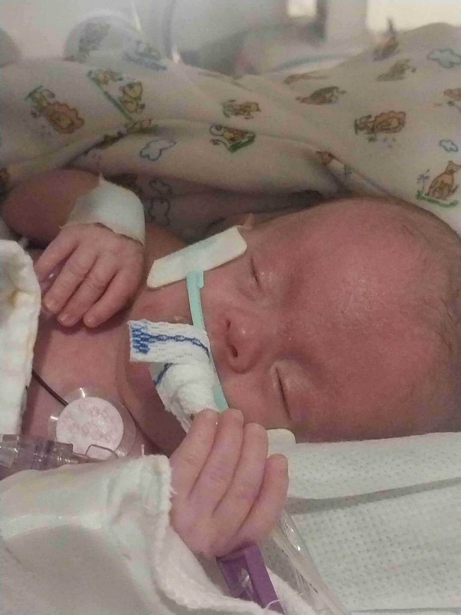 Zoee Wisecarver Trisomy 18 with older sister Journey at the NICU