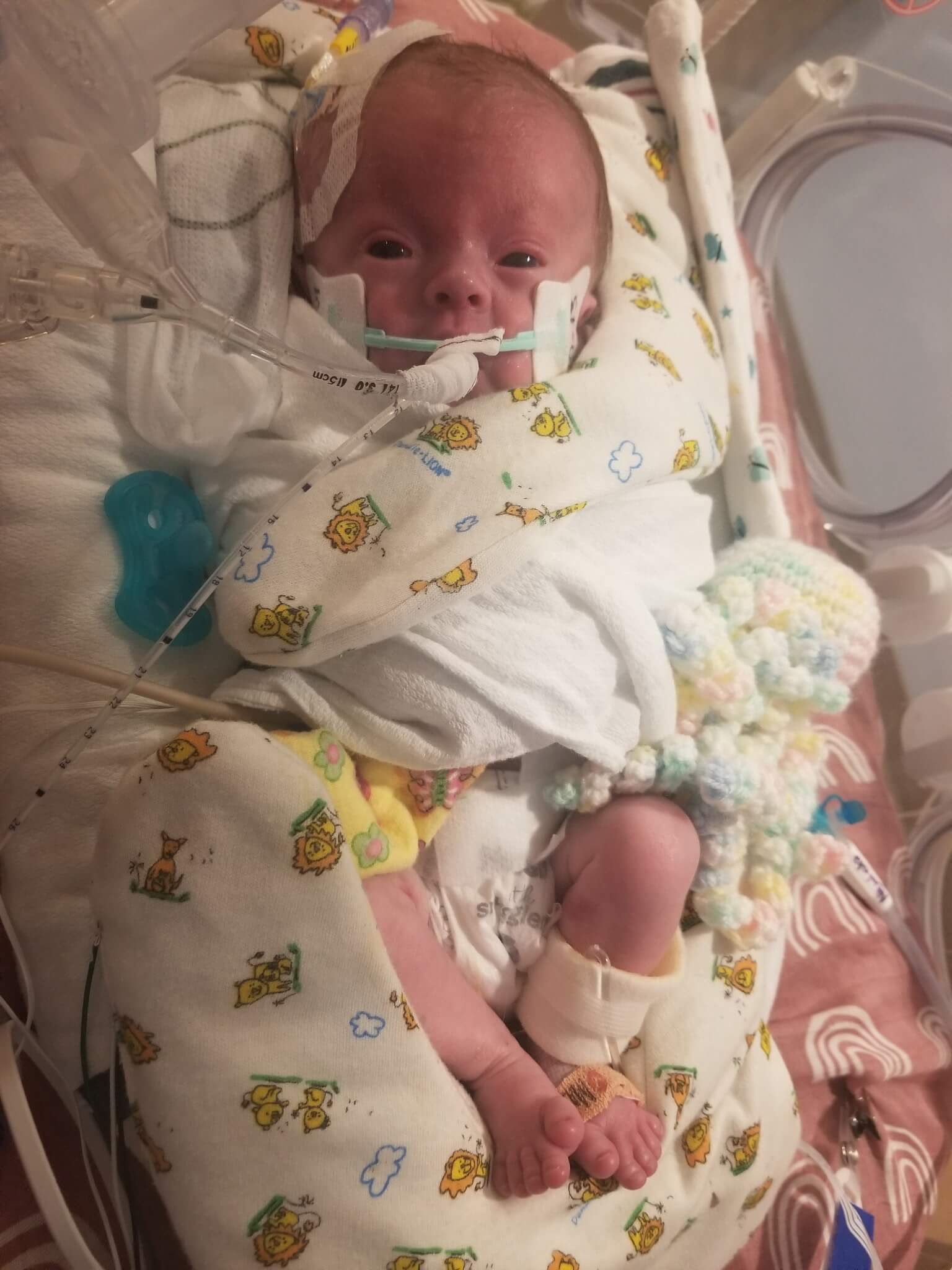 Zoee Wisecarver Trisomy 18 Edwards syndrome in the NICU with family