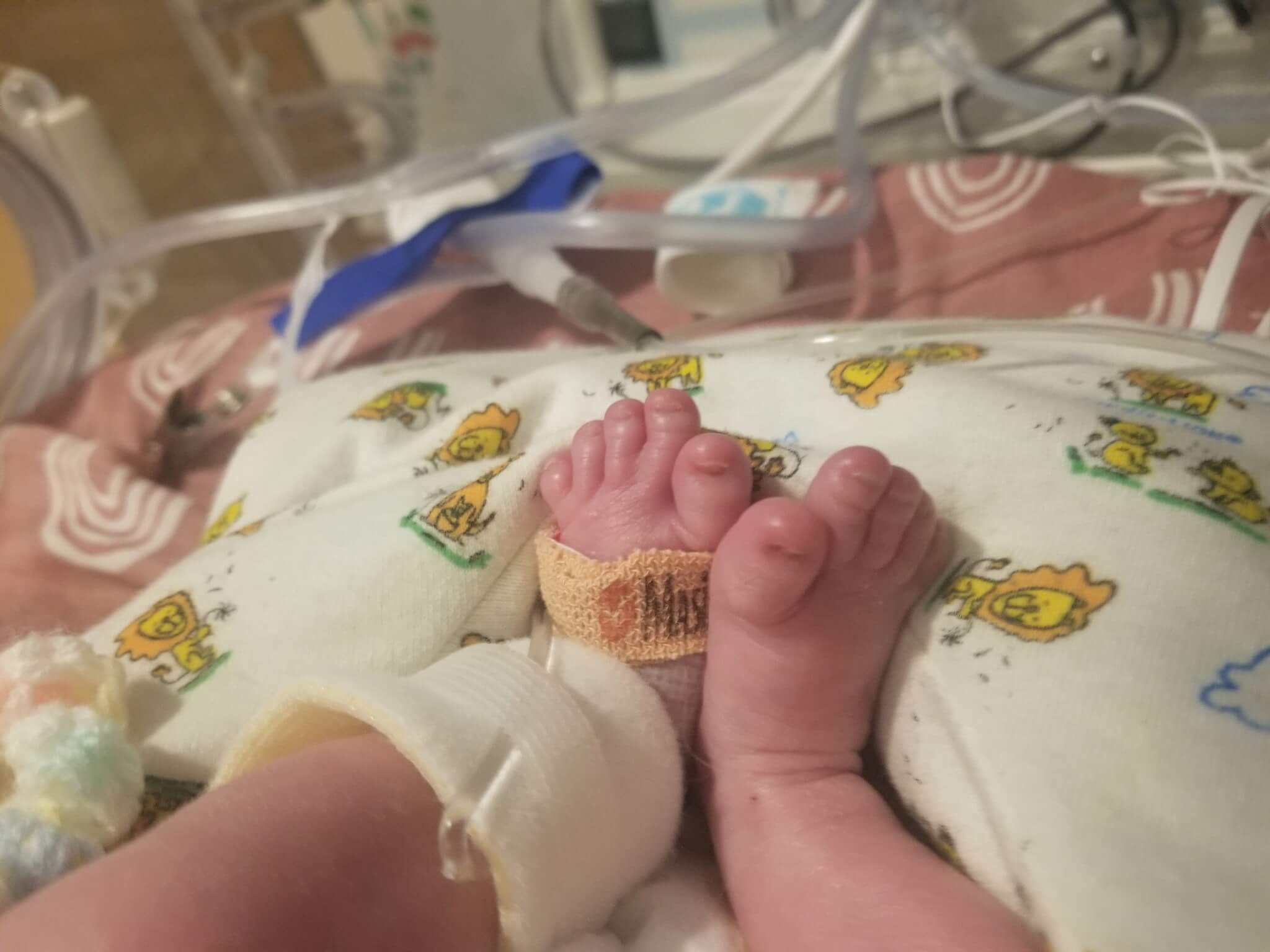 Zoee Wisecarver Trisomy 18 Edwards syndrome in the NICU with Sarah and Darren Wisecarver
