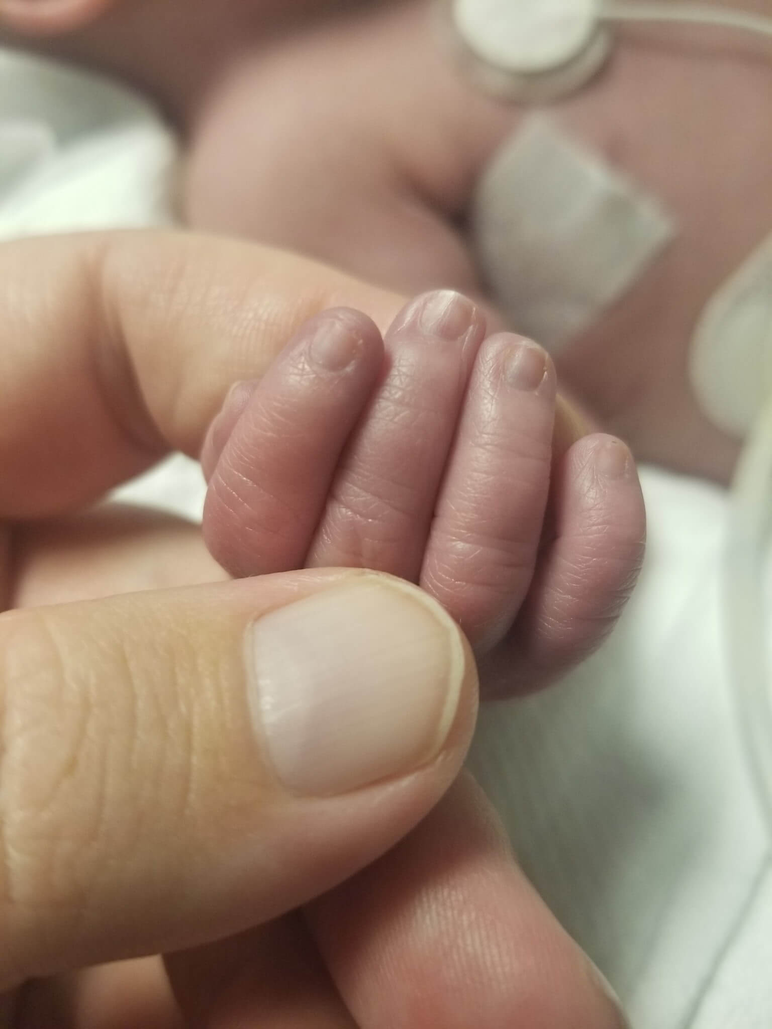 Zoee Wisecarver Trisomy 18 Edwards syndrome newborn in the NICU